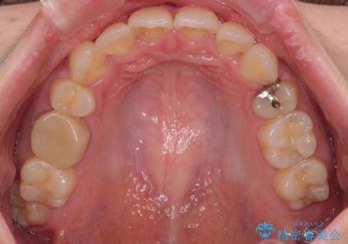 前歯のデコボコを抜歯矯正でスッキリした口元にの治療後