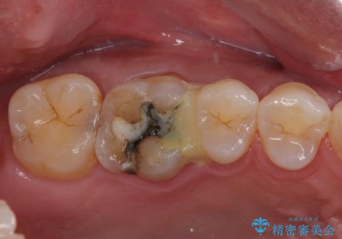 銀の詰め物が外れた　ハイブリッドアンレー修復の症例 治療前