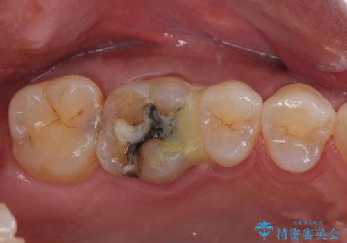銀の詰め物が外れた ハイブリッドアンレー修復の症例 治療前
