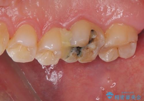 銀の詰め物が外れた ハイブリッドアンレー修復の治療前