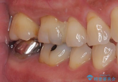 銀の詰め物が外れた ハイブリッドアンレー修復の治療前