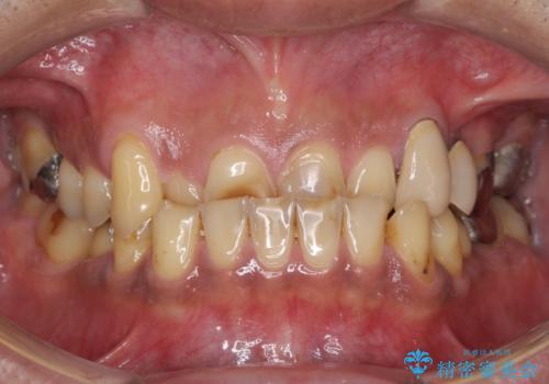 反対咬合ですり減った前歯とむし歯だらけの奥歯 総合歯科治療の症例 治療前