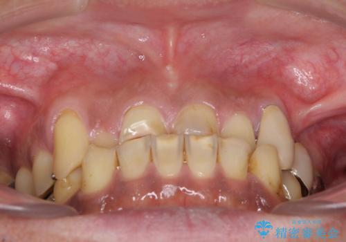 反対咬合ですり減った前歯とむし歯だらけの奥歯 総合歯科治療の治療前