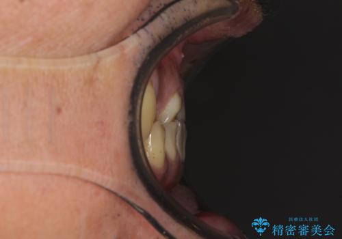 反対咬合ですり減った前歯とむし歯だらけの奥歯 総合歯科治療の治療前