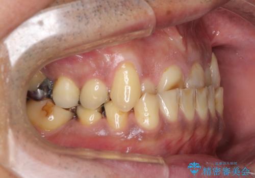 反対咬合ですり減った前歯とむし歯だらけの奥歯 総合歯科治療の治療前
