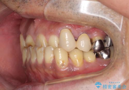 反対咬合ですり減った前歯とむし歯だらけの奥歯 総合歯科治療の治療前