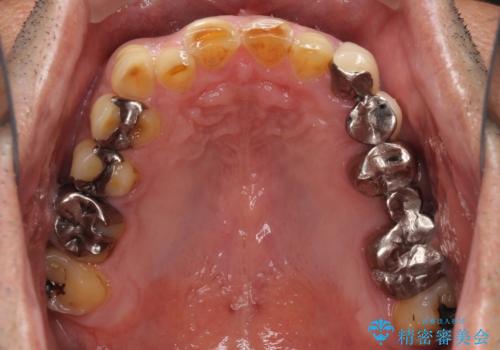 反対咬合ですり減った前歯とむし歯だらけの奥歯 総合歯科治療の治療前