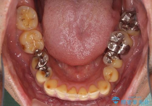 反対咬合ですり減った前歯とむし歯だらけの奥歯 総合歯科治療の治療前