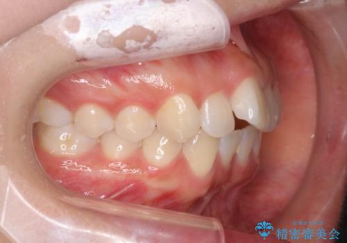 先天性の2歯欠損 個性を活かしたマウスピース矯正の治療前