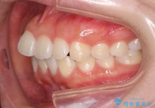 先天性の2歯欠損 個性を活かしたマウスピース矯正の治療前