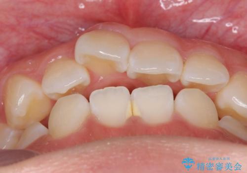 先天性の2歯欠損 個性を活かしたマウスピース矯正の治療前