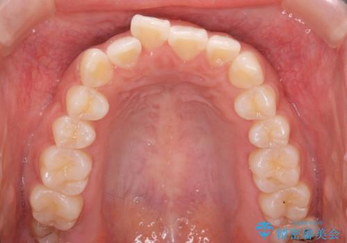 先天性の2歯欠損 個性を活かしたマウスピース矯正の治療前