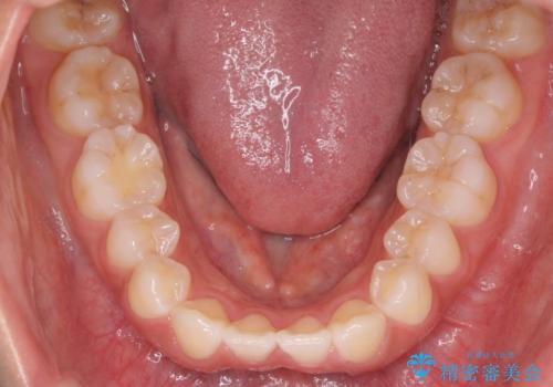 先天性の2歯欠損 個性を活かしたマウスピース矯正の治療前