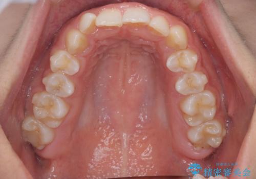インビザラインで整える深い噛み合わせの治療中