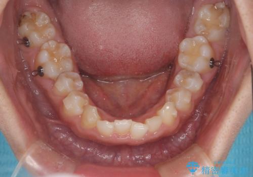 インビザラインで整える深い噛み合わせの治療中