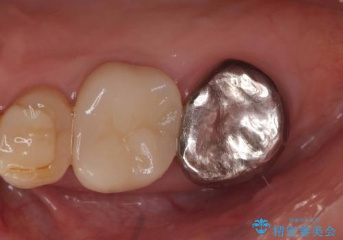 【セラミッククラウン】銀歯をオールセラミックに!の症例 治療前