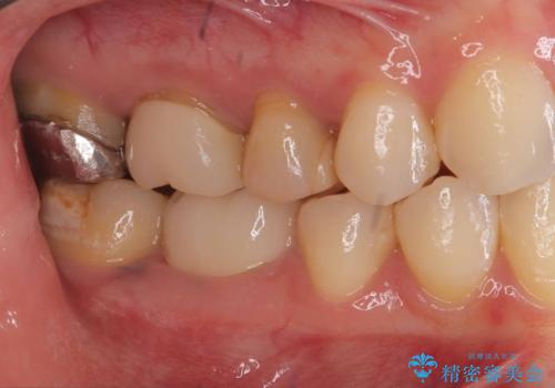 【セラミッククラウン】銀歯をオールセラミックに!の治療前