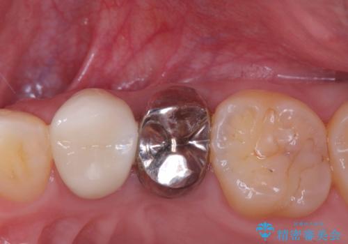 【セラッミククラウン】銀歯を白くしたい!の症例 治療前