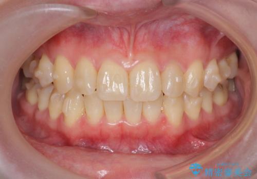 前歯のねじれを治したい リーズナブルなインビザラインモデレートプランの治療中