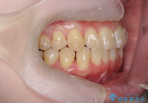 前歯のねじれを治したい リーズナブルなインビザラインモデレートプランの治療中