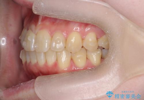 前歯のねじれを治したい リーズナブルなインビザラインモデレートプランの治療中
