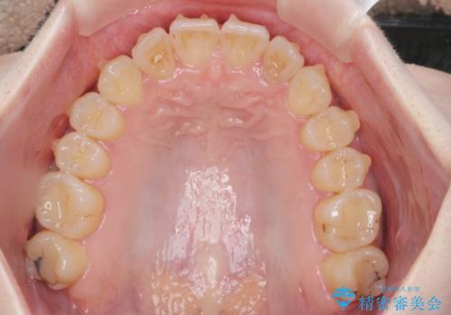 前歯のねじれを治したい リーズナブルなインビザラインモデレートプランの治療中