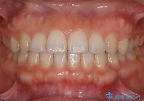 マウスピースで効率的にすきっ歯を治すの治療後