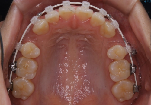 どこで噛んだらいいのかわからない:ワイヤーによる矯正治療の治療中