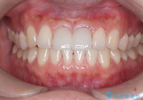 歯の着色にはエアフローの治療後