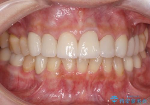 50代女性 銀歯をとって白いつめものに 全体的な治療の症例 治療後