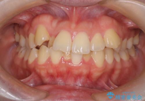 結婚式に向けた歯列矯正の症例 治療前