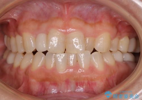 審美性と機能を改善! インビザライン矯正の治療中