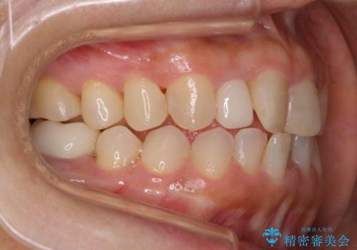 審美性と機能を改善! インビザライン矯正の治療中