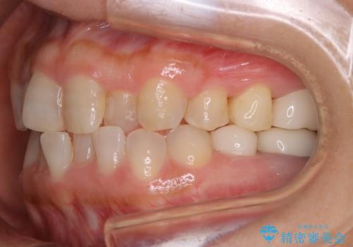 審美性と機能を改善! インビザライン矯正の治療中