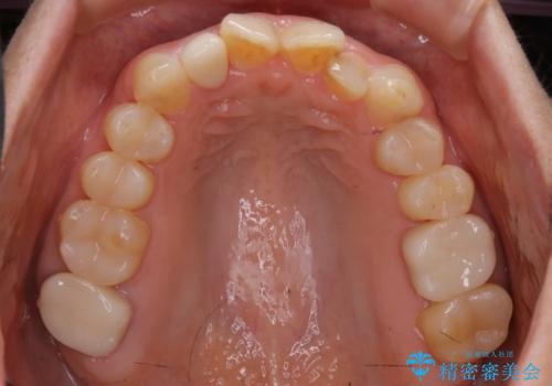 審美性と機能を改善! インビザライン矯正の治療中