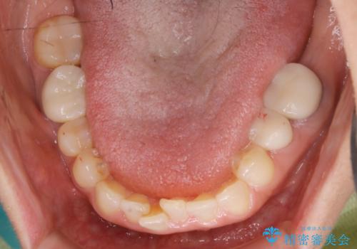 審美性と機能を改善! インビザライン矯正の治療中