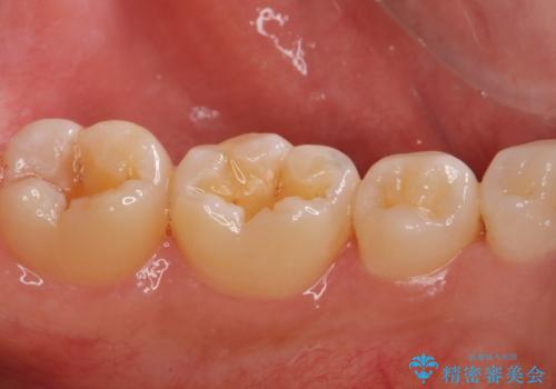 【歯に穴が空いている】ゴールドインレーで修復の治療前