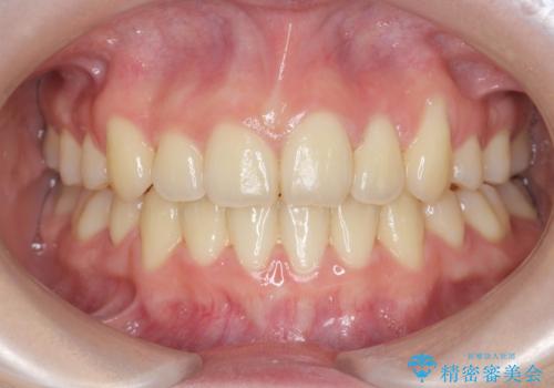 歯並びのせいで歯ブラシがしづらい マルチブラケットを用いた抜歯矯正の症例 治療後