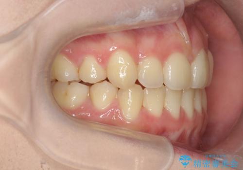 歯並びのせいで歯ブラシがしづらい マルチブラケットを用いた抜歯矯正の治療後