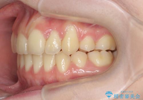 歯並びのせいで歯ブラシがしづらい マルチブラケットを用いた抜歯矯正の治療後