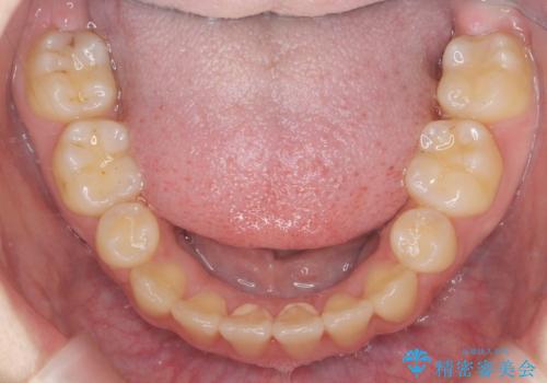 歯並びのせいで歯ブラシがしづらい マルチブラケットを用いた抜歯矯正の治療後