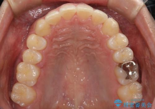 インビザラインで八重歯の治療の治療後