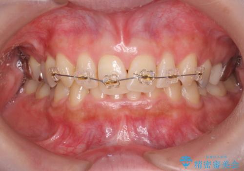 [前歯のねじれ 部分]ワイヤーとマウスピースの併用矯正治療　の治療前