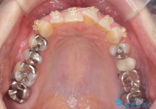 [前歯のねじれ 部分]ワイヤーとマウスピースの併用矯正治療　の治療前