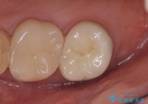 【セラミッククラウン】銀歯をオールセラミックに!の症例 治療後