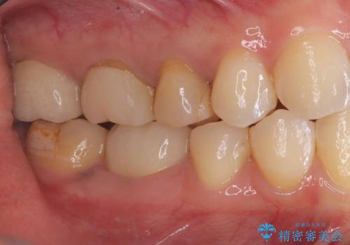 【セラミッククラウン】銀歯をオールセラミックに!の治療後