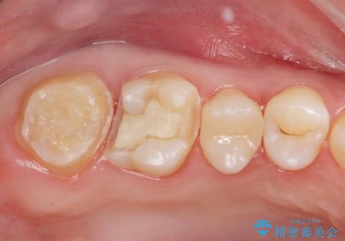奥歯の虫歯の治療　の治療中