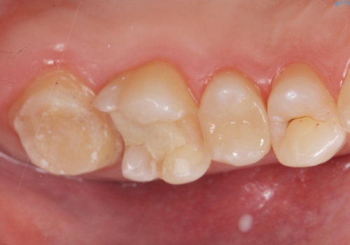 奥歯の虫歯の治療　の治療中