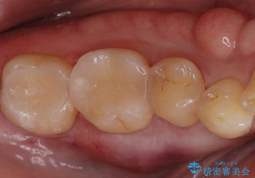 セラミックインレー。の症例 治療後