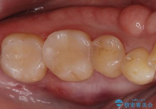 セラミックインレー。の治療後